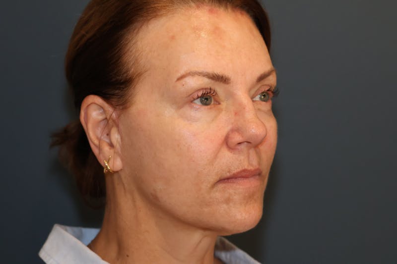 Facelift Before & After Gallery - Patient 101067 - Image 4