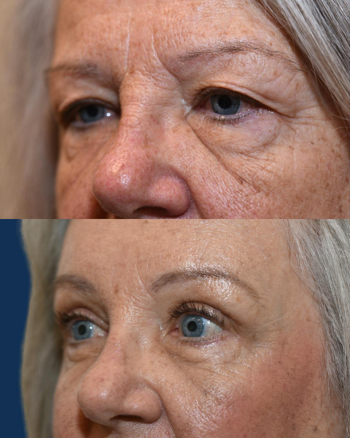 Endoscopic Brow Lift with Upper Blepharoplasty Before & After Gallery - Patient 289741 - Image 2