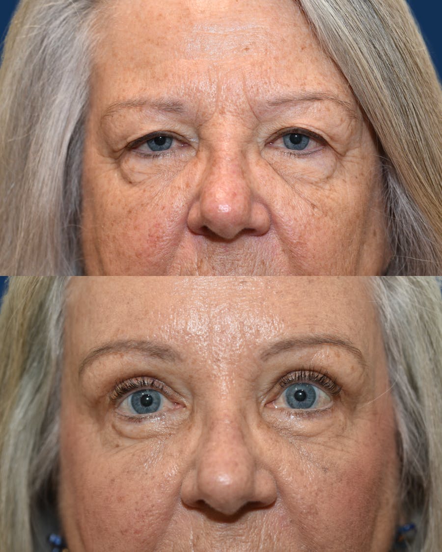 Endoscopic Brow Lift with Upper Blepharoplasty Before & After Gallery - Patient 289741 - Image 1