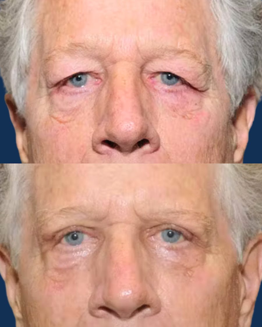 Upper Blepharoplasty Before & After Gallery - Patient 302545 - Image 1