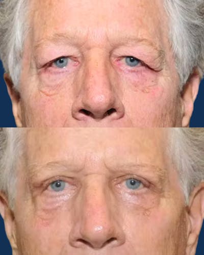 Upper Blepharoplasty Before & After Gallery - Patient 302545 - Image 1