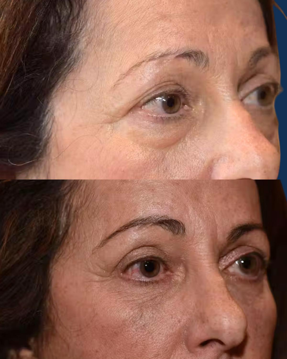 Upper Blepharoplasty Before & After Gallery - Patient 347552 - Image 2