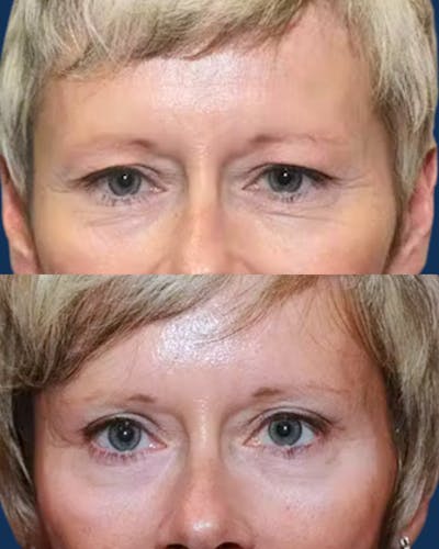 Endoscopic Brow Lift with Upper Blepharoplasty Before & After Gallery - Patient 348678 - Image 1