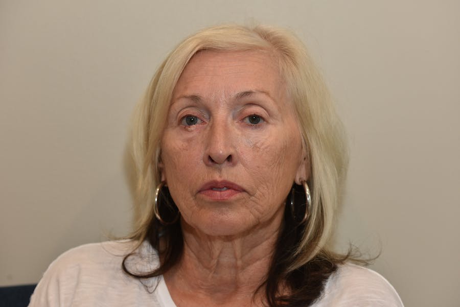 CO2 Laser Resurfacing Before & After Gallery - Patient 321900 - Image 1