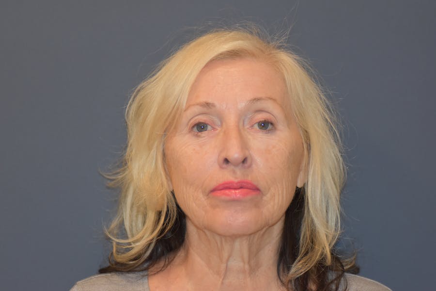 CO2 Laser Resurfacing Before & After Gallery - Patient 321900 - Image 2