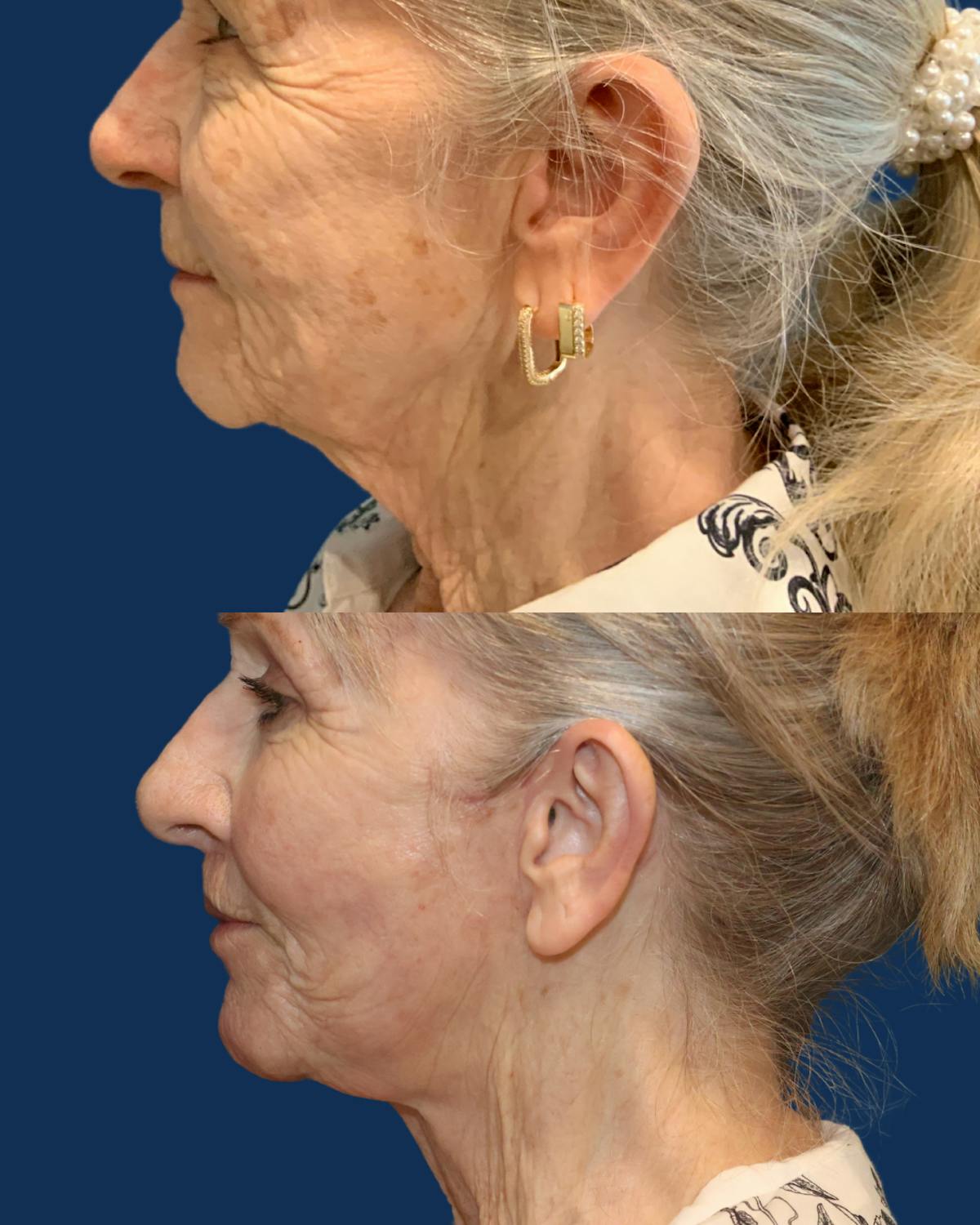 Endoscopic Brow Lift with Upper Blepharoplasty Before & After Gallery - Patient 538389 - Image 3