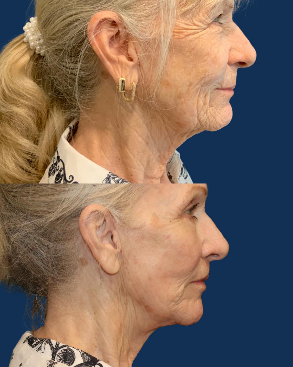 Endoscopic Brow Lift with Upper Blepharoplasty Before & After Gallery - Patient 538389 - Image 5