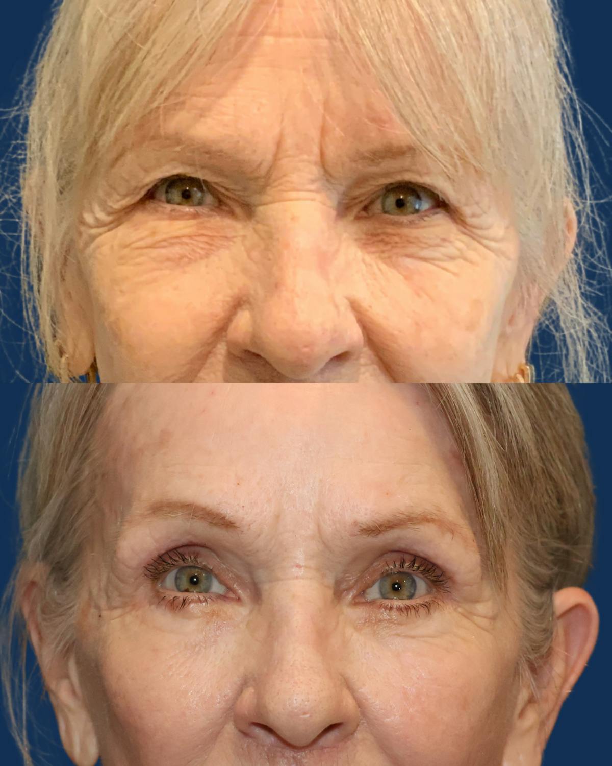 Lower Blepharoplasty Before & After Gallery - Patient 691679 - Image 1