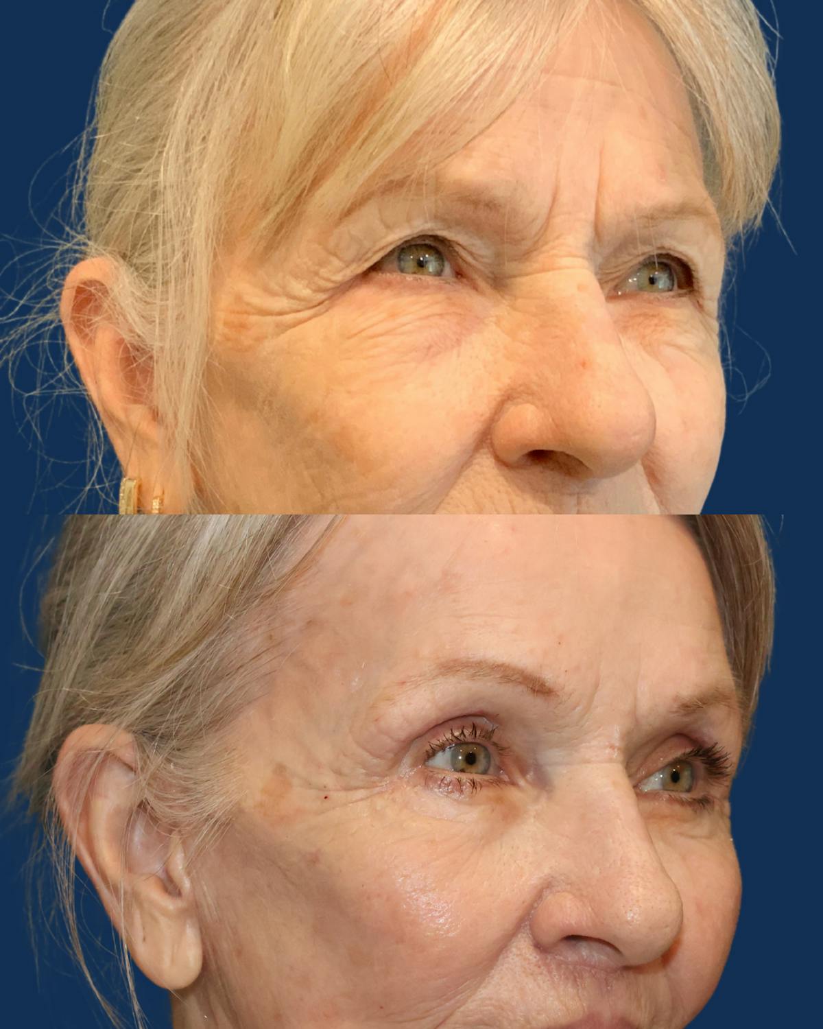 Lower Blepharoplasty Before & After Gallery - Patient 691679 - Image 3