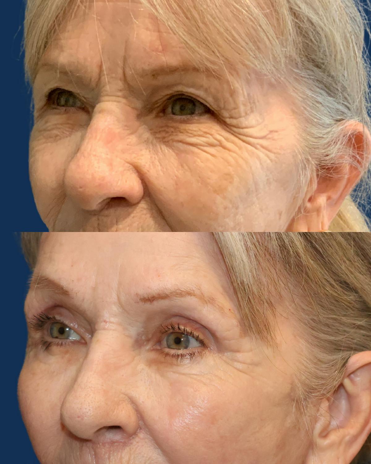 Lower Blepharoplasty Before & After Gallery - Patient 691679 - Image 2