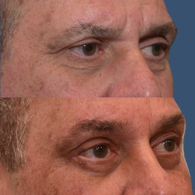 Endoscopic Brow Lift with Upper Blepharoplasty Before & After Gallery - Patient 232835 - Image 1