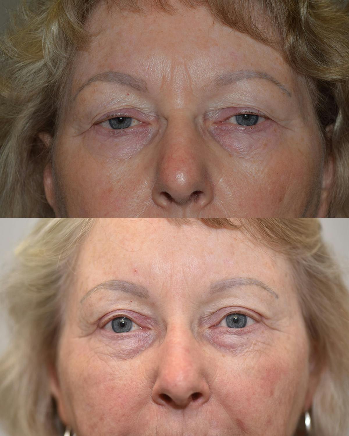 Upper Blepharoplasty Before & After Gallery - Patient 310011 - Image 1