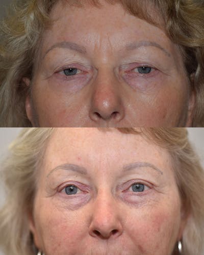 Upper Blepharoplasty Before & After Gallery - Patient 310011 - Image 1