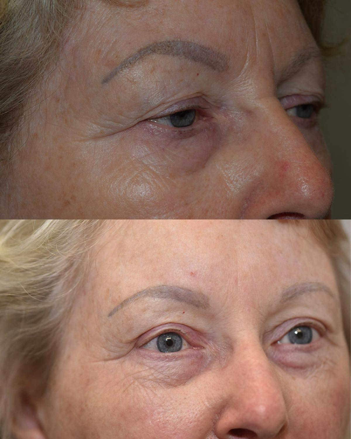 Upper Blepharoplasty Before & After Gallery - Patient 310011 - Image 2