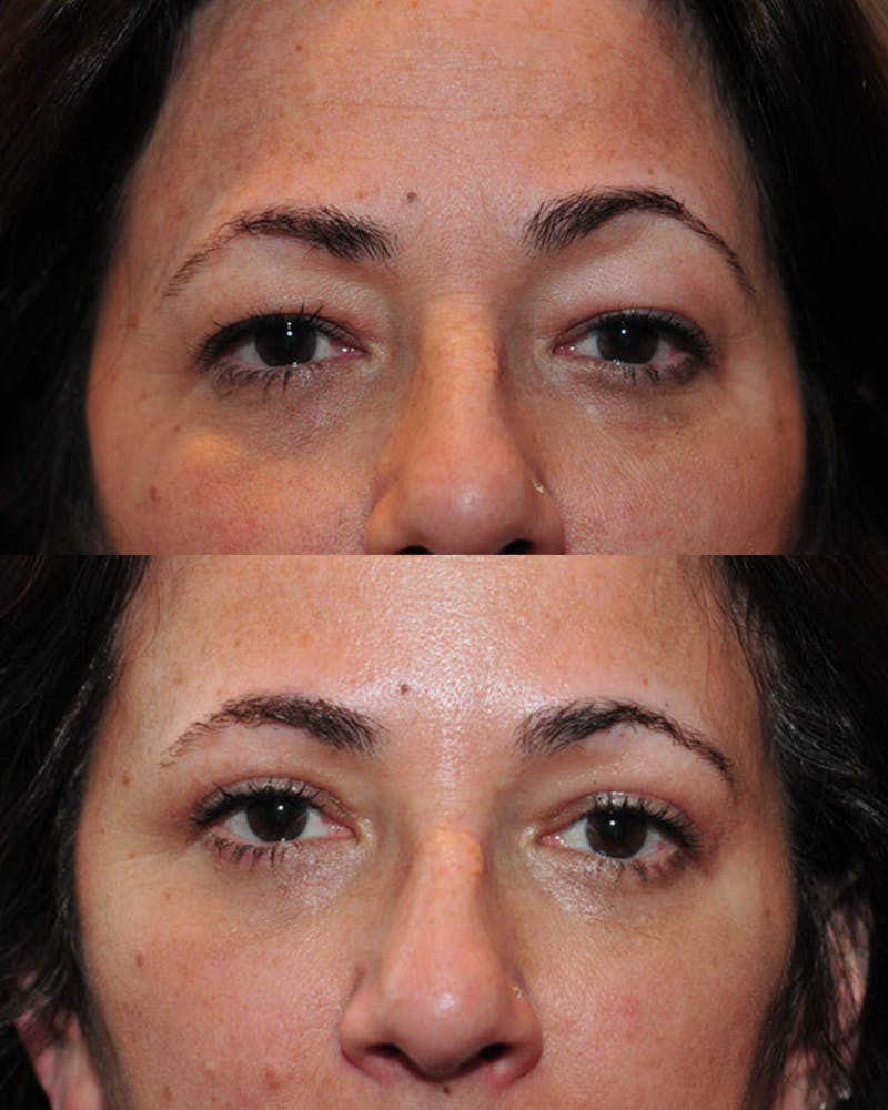 Upper Blepharoplasty Before & After Gallery - Patient 265842 - Image 1