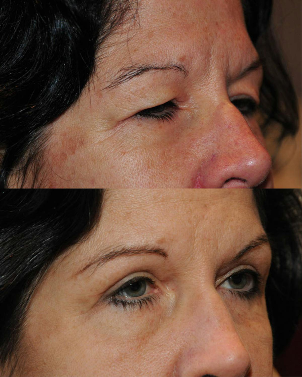 Upper Blepharoplasty Before & After Gallery - Patient 404741 - Image 2
