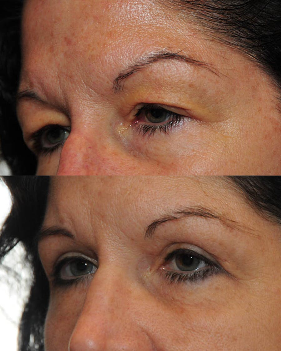 Upper Blepharoplasty Before & After Gallery - Patient 404741 - Image 1