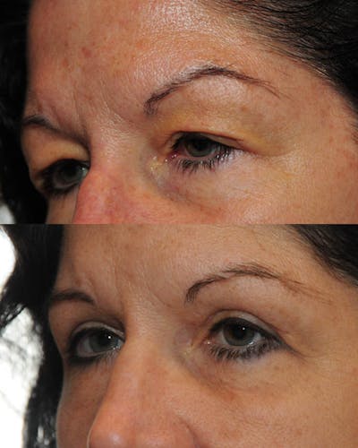 Upper Blepharoplasty Before & After Gallery - Patient 404741 - Image 1