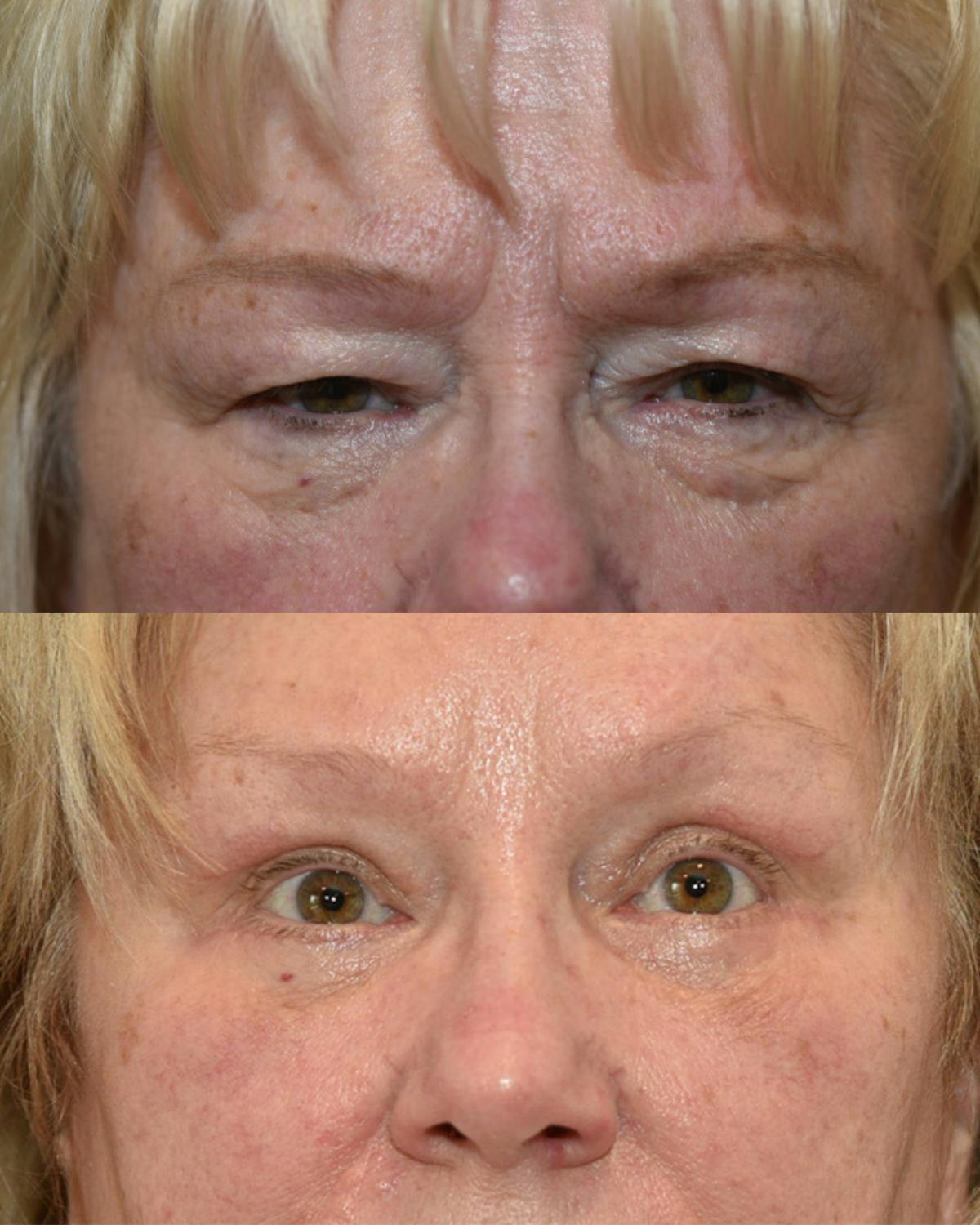 Lower Blepharoplasty Before & After Gallery - Patient 117120 - Image 1
