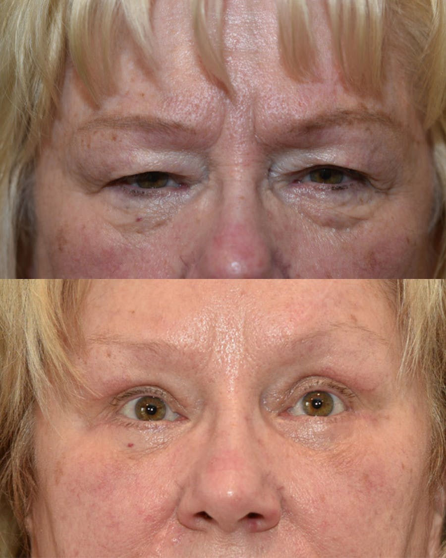 Lower Blepharoplasty Before & After Gallery - Patient 117120 - Image 1