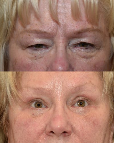 Lower Blepharoplasty Before & After Gallery - Patient 117120 - Image 1