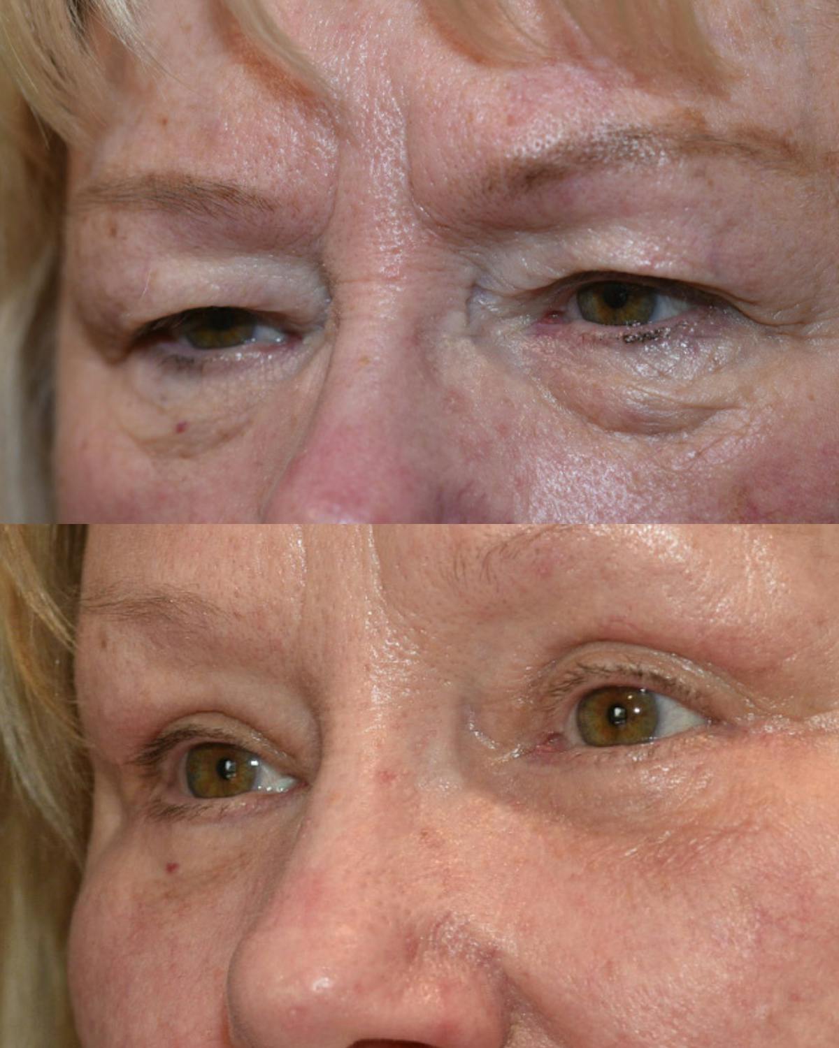 Lower Blepharoplasty Before & After Gallery - Patient 117120 - Image 2