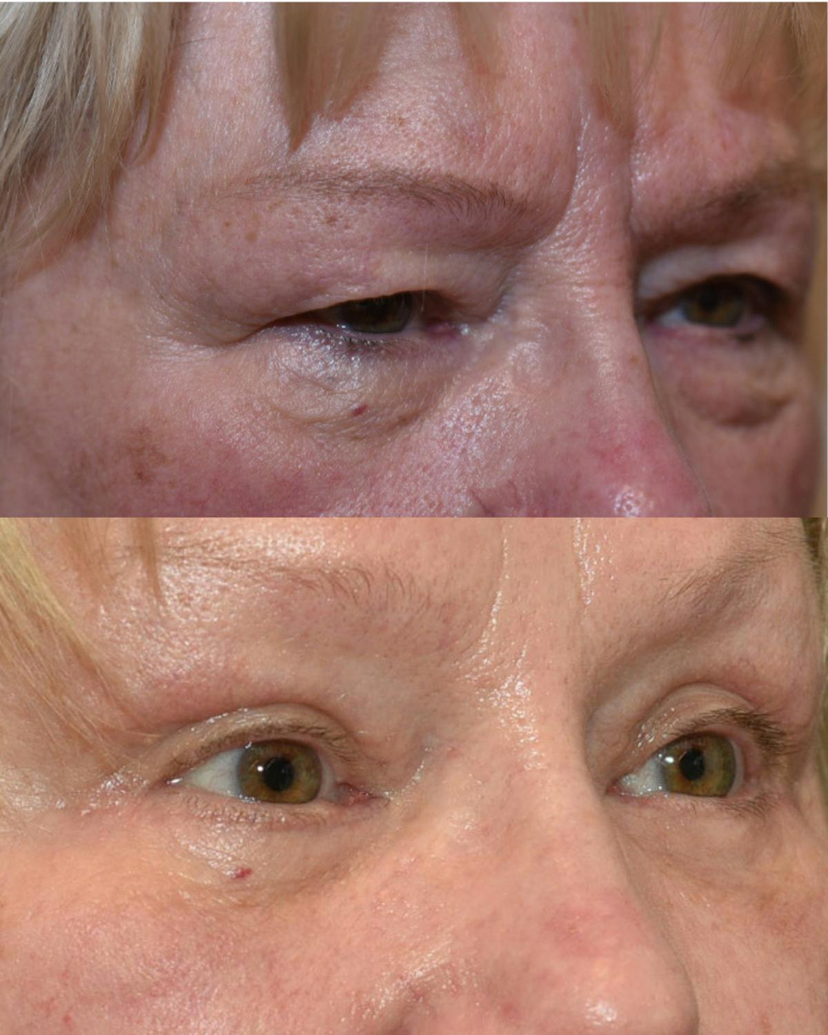 Lower Blepharoplasty Before & After Gallery - Patient 117120 - Image 3