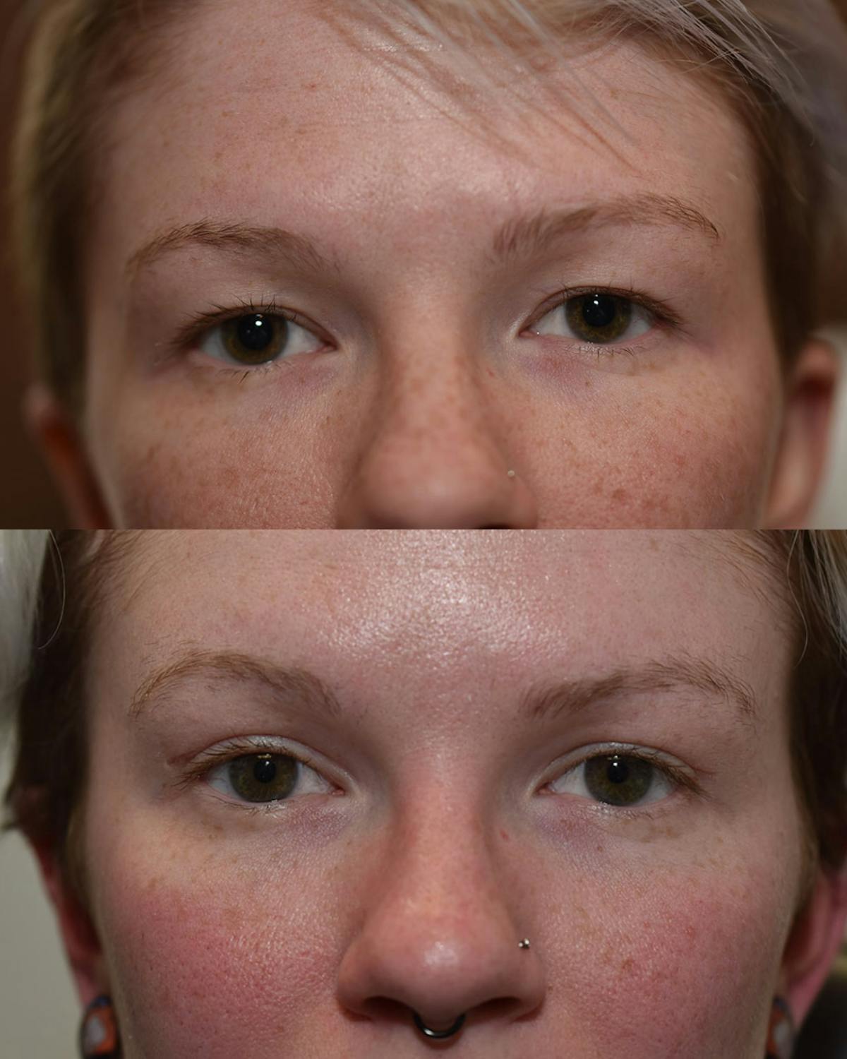 Endoscopic Brow Lift Before & After Gallery - Patient 105392 - Image 1