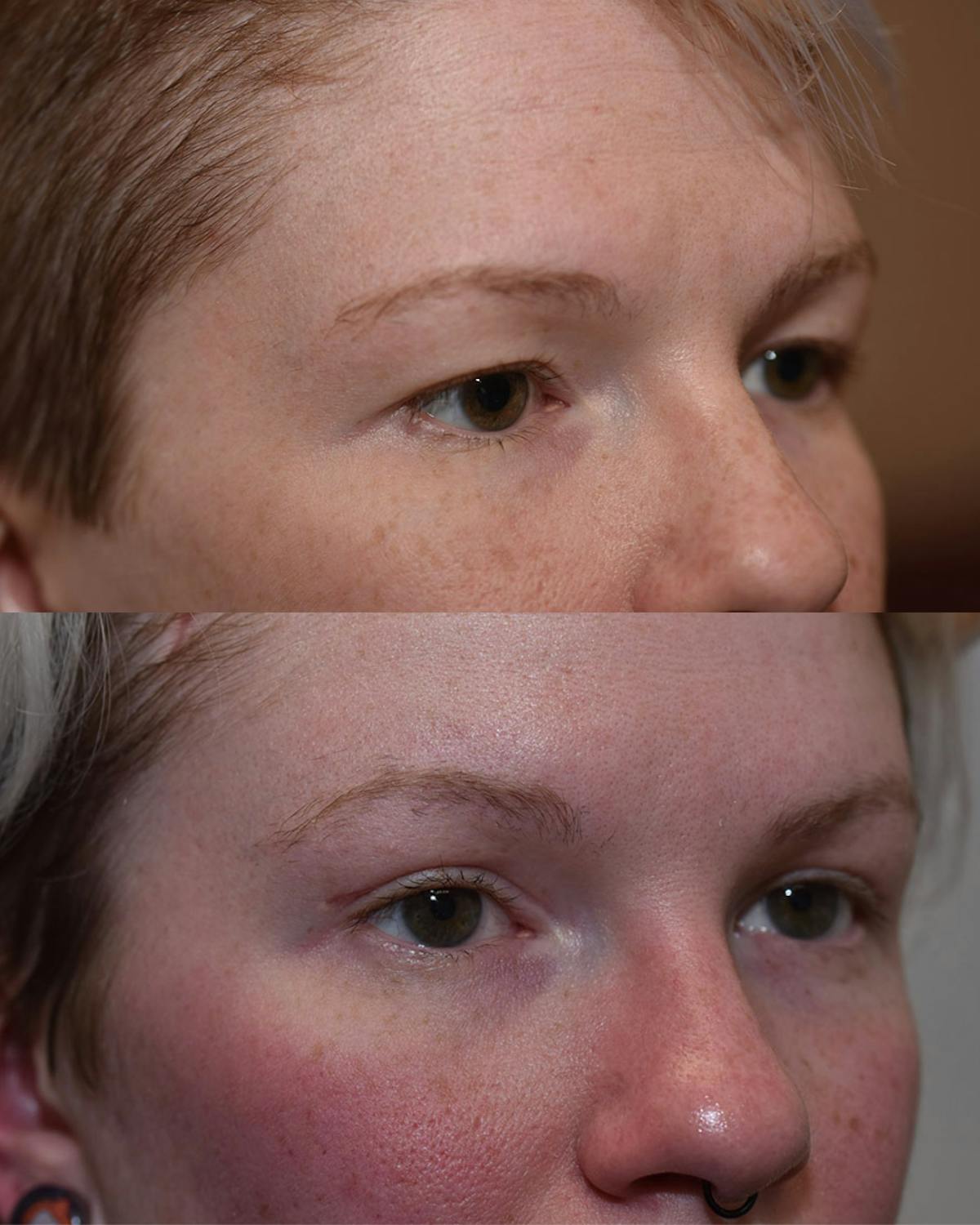 Endoscopic Brow Lift Before & After Gallery - Patient 105392 - Image 2