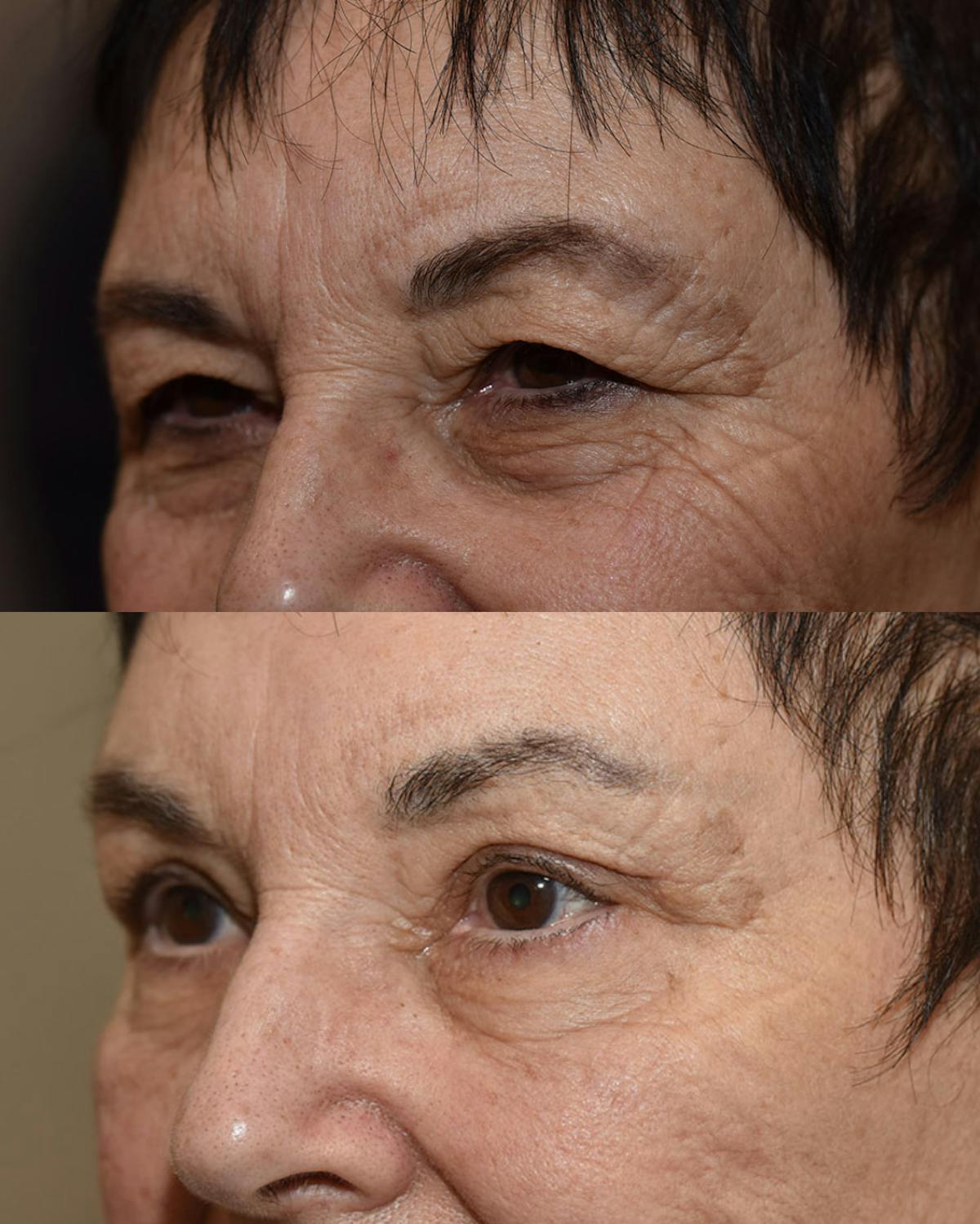 Endoscopic Brow Lift Before & After Gallery - Patient 138207 - Image 2