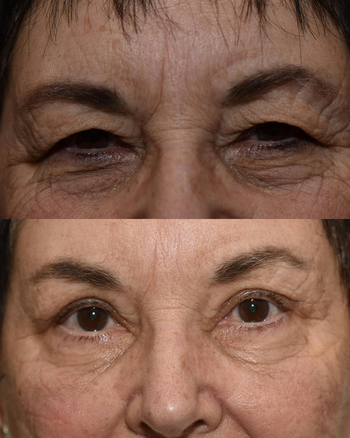 Endoscopic Brow Lift Before & After Gallery - Patient 138207 - Image 1