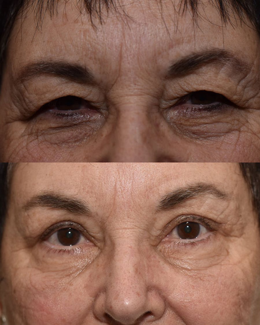 Endoscopic Brow Lift Before & After Gallery - Patient 138207 - Image 1
