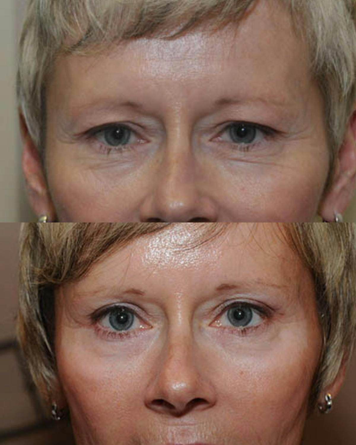 Endoscopic Brow Lift Before & After Gallery - Patient 247601 - Image 1