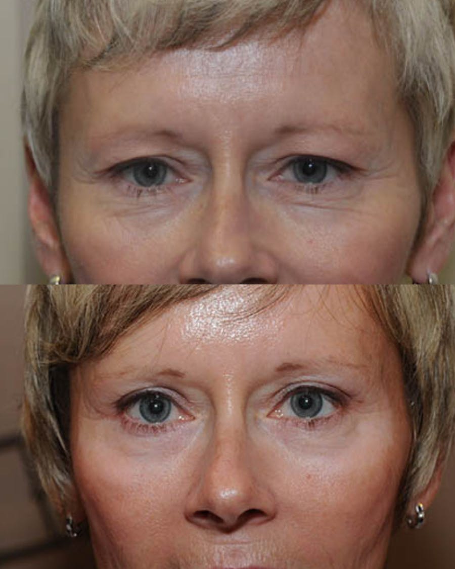 Endoscopic Brow Lift Before & After Gallery - Patient 247601 - Image 1