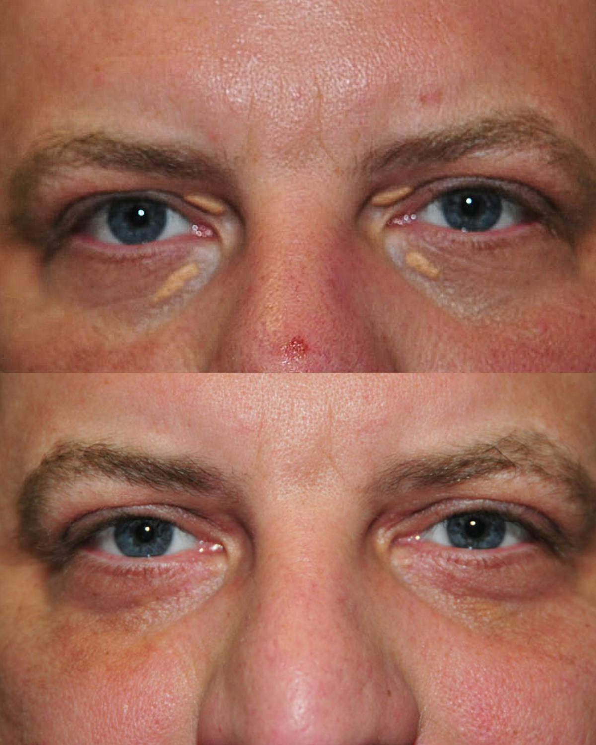 Cosmetic Lesion/Mole Removal Before & After Gallery - Patient 144111 - Image 1