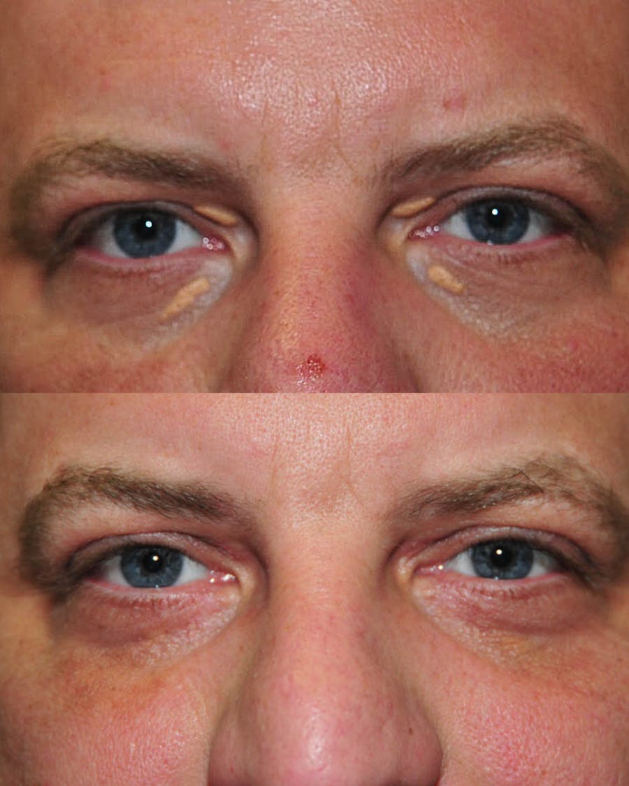 Cosmetic Lesion/Mole Removal Before & After Gallery - Patient 144111 - Image 1