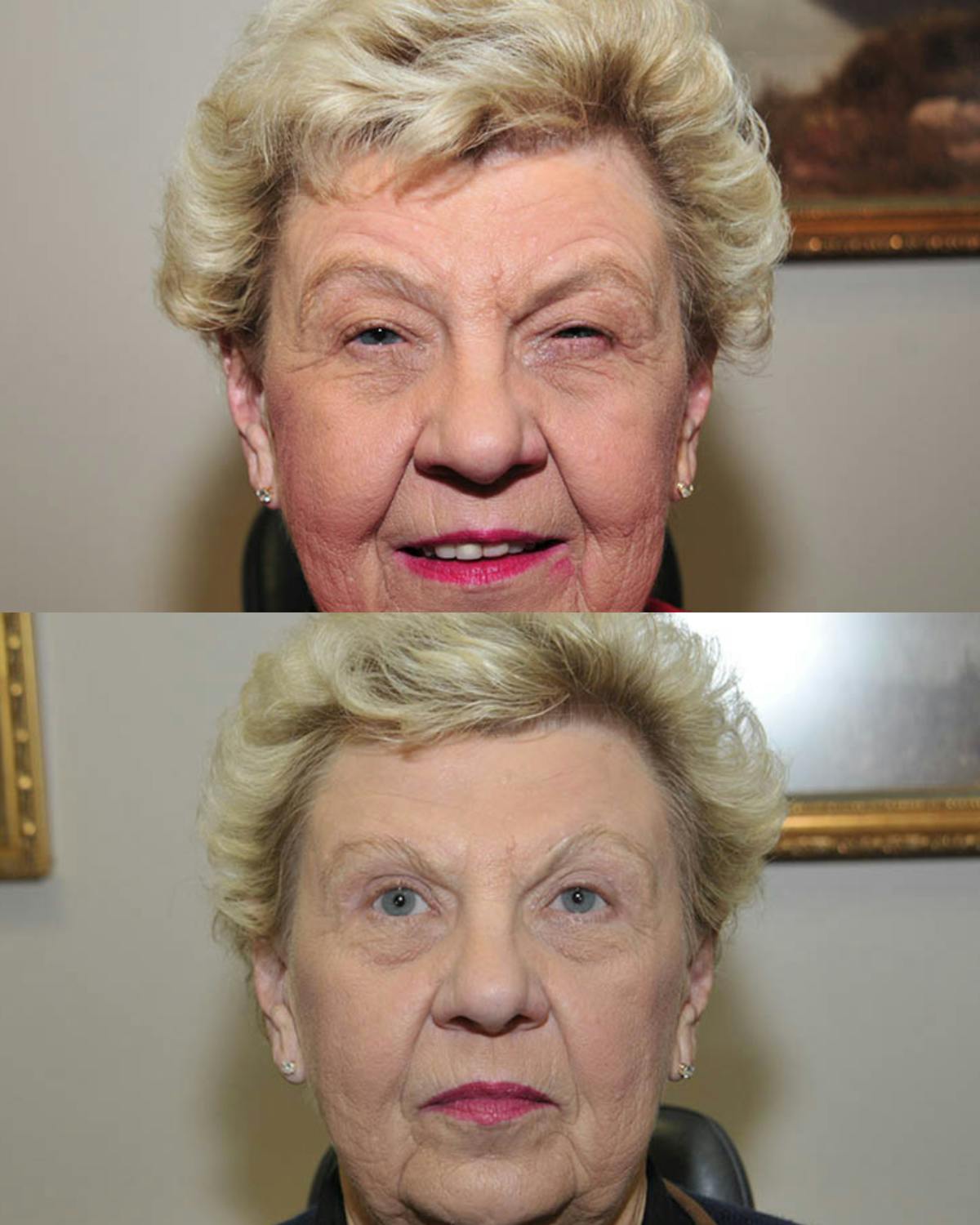 Direct Brow Lift Before & After Gallery - Patient 263829 - Image 2