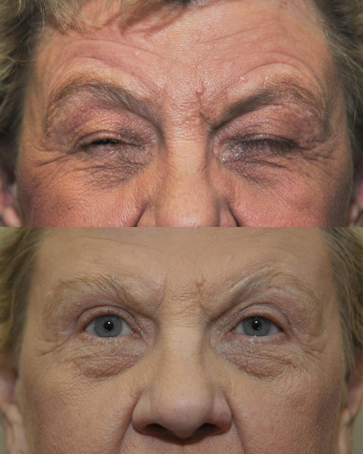 Direct Brow Lift Before & After Gallery - Patient 263829 - Image 1