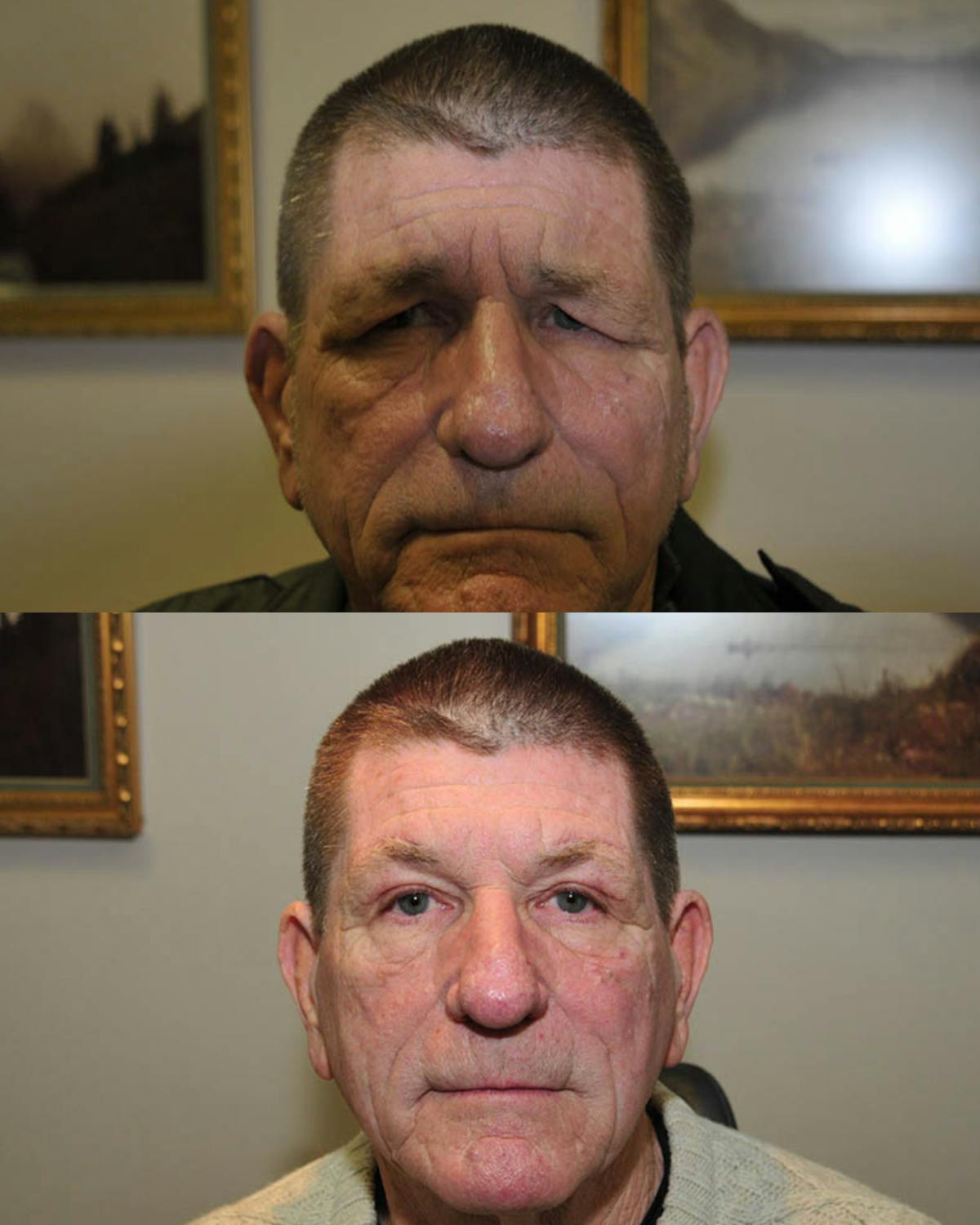 Direct Brow Lift Before & After Gallery - Patient 850552 - Image 2