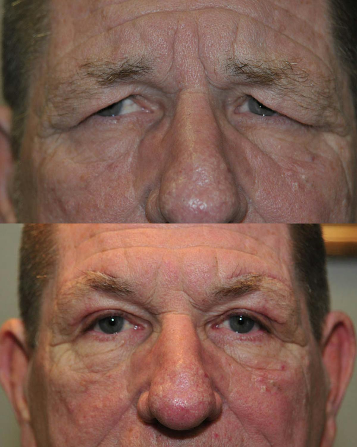 Direct Brow Lift Before & After Gallery - Patient 850552 - Image 1