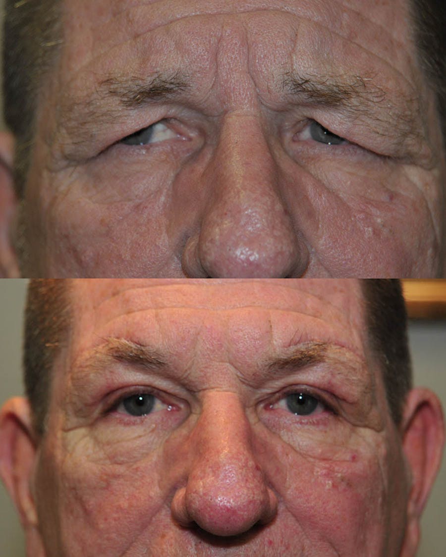 Direct Brow Lift Before & After Gallery - Patient 850552 - Image 1