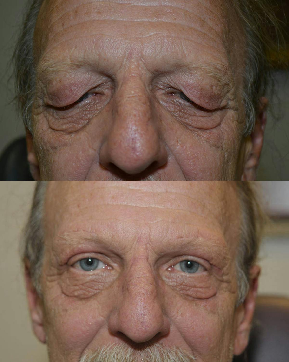 Direct Brow Lift Before & After Gallery - Patient 808829 - Image 1