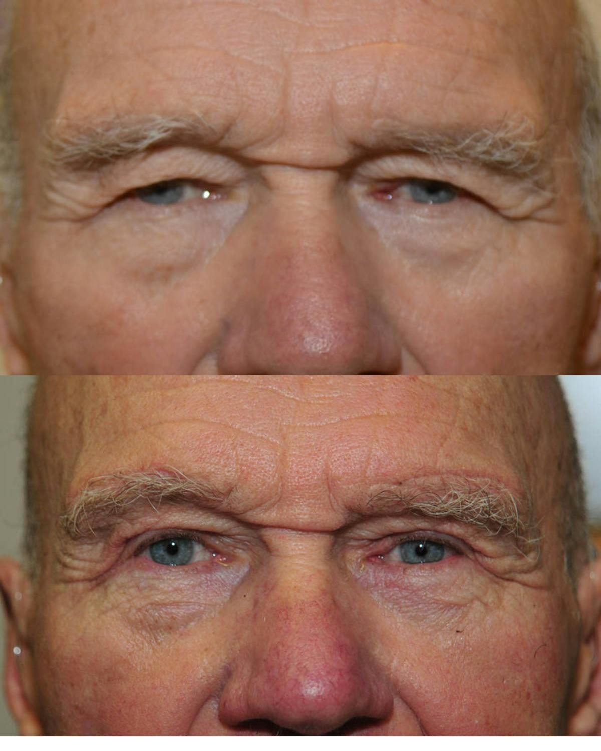 Direct Brow Lift Before & After Gallery - Patient 410798 - Image 1