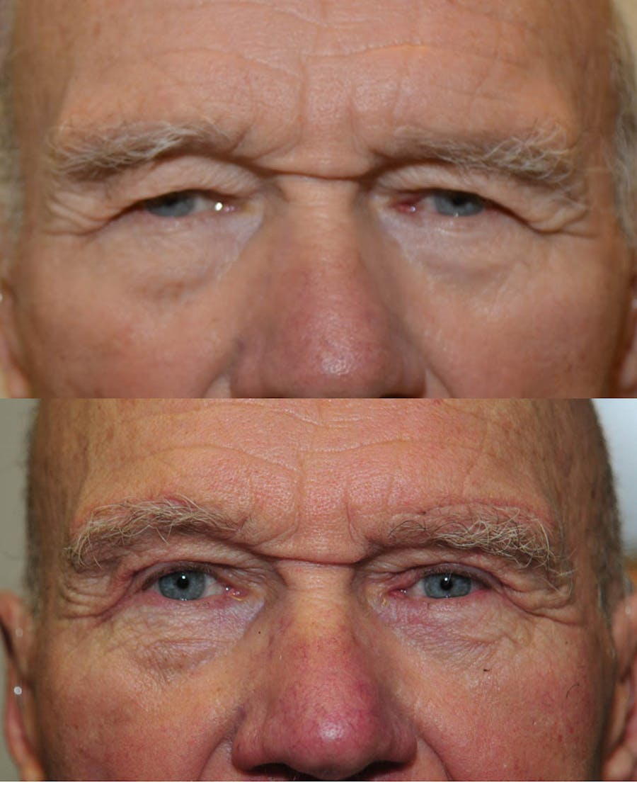 Direct Brow Lift Before & After Gallery - Patient 410798 - Image 1
