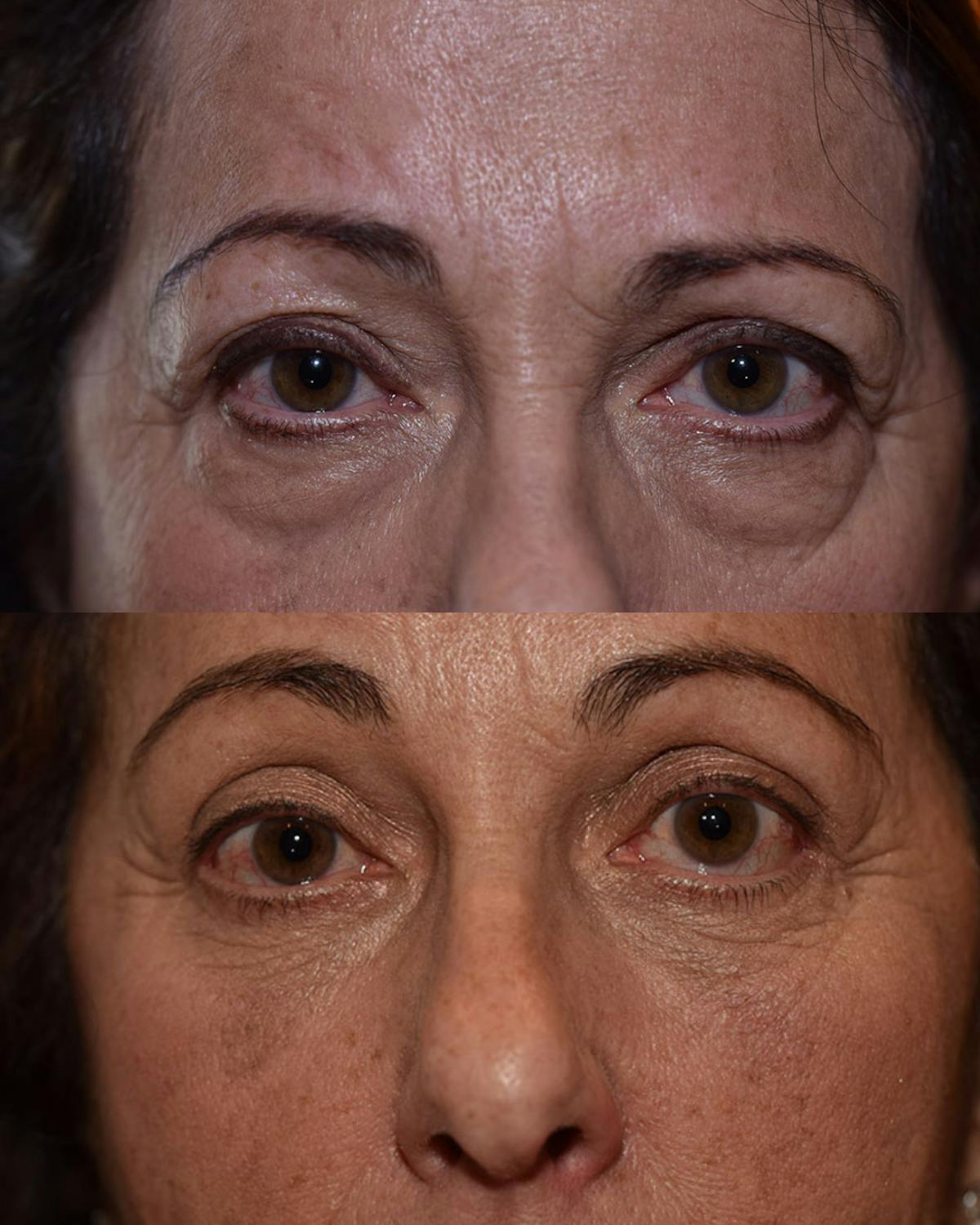Upper Blepharoplasty Before & After Gallery - Patient 347552 - Image 1