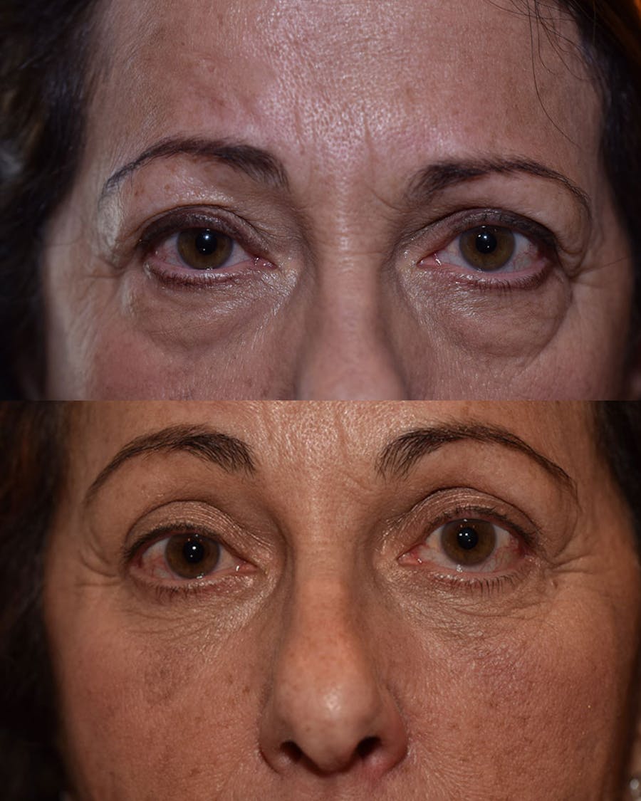 Endoscopic Brow Lift Before & After Gallery - Patient 271714 - Image 1