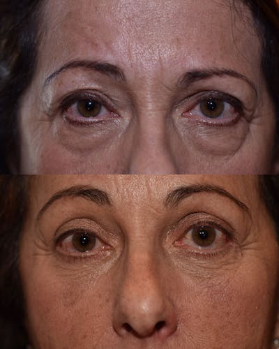 Upper Blepharoplasty Before & After Gallery - Patient 347552 - Image 1