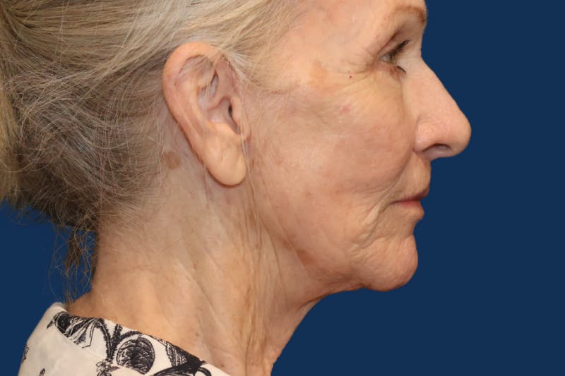 Facelift Before & After Gallery - Patient 335259 - Image 4