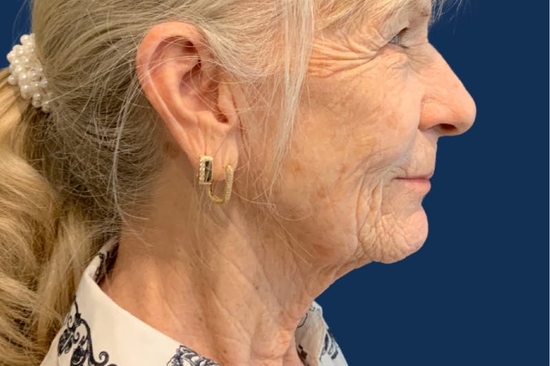Facelift Before & After Gallery - Patient 335259 - Image 3