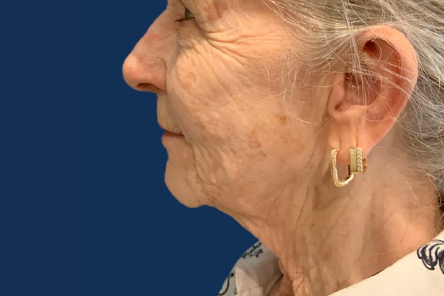 Facelift Before & After Gallery - Patient 335259 - Image 1